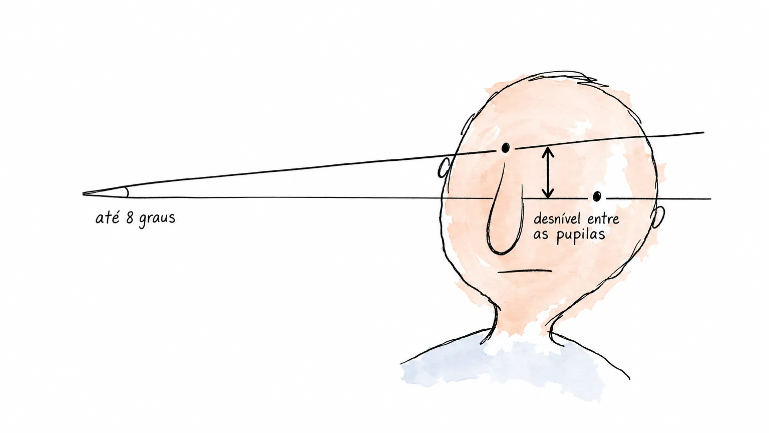 Cabeça de traço solto com a linha dos olhos subindo sobre uma horizontal: a cunha traz até 8 graus e a seta entre as pupilas marca o desnível entre elas.